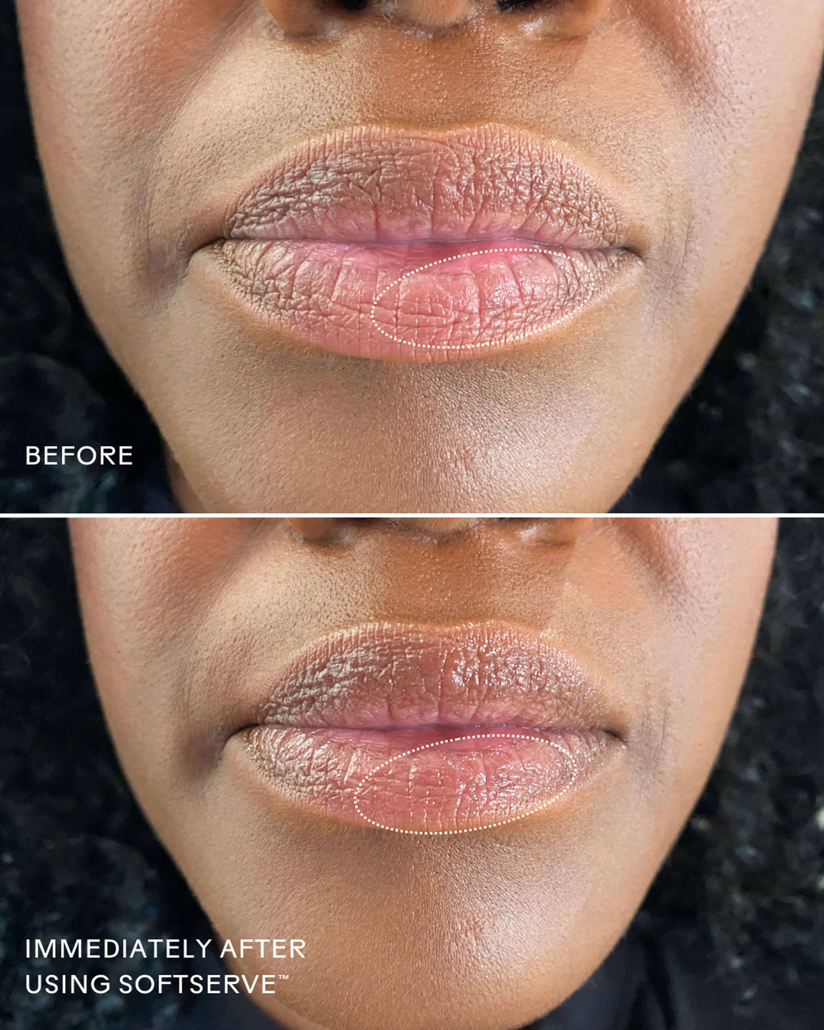SoftServe Lip Treatment
